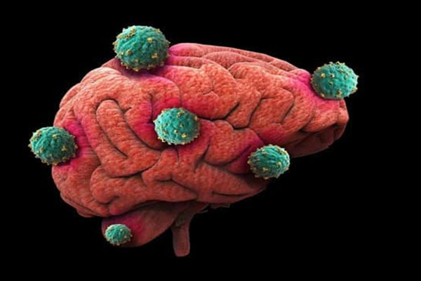 بیماری‌های مغز و اعصاب چیست؟