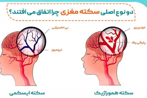 انواع سکته مغزی