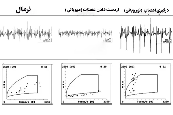 تفاوت نوار مغز سالم و ناسالم